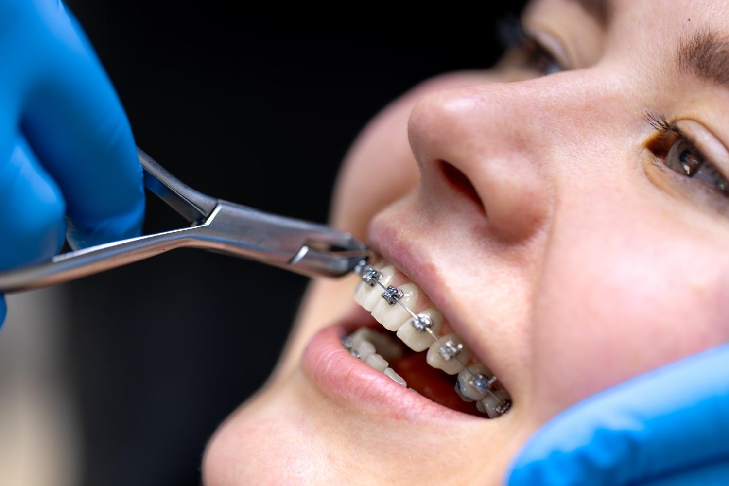 Orthodontic Braces