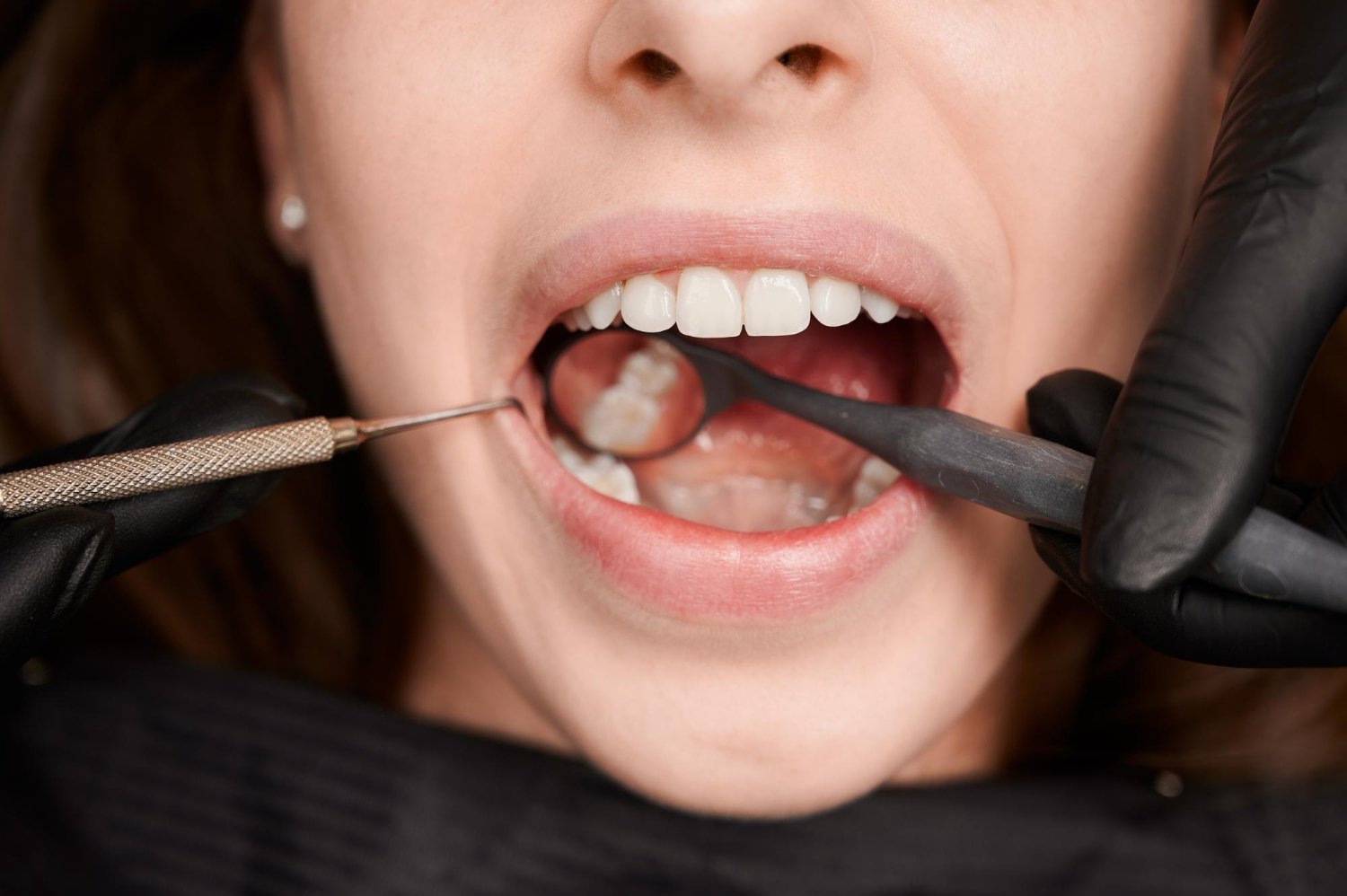 Tooth Extraction